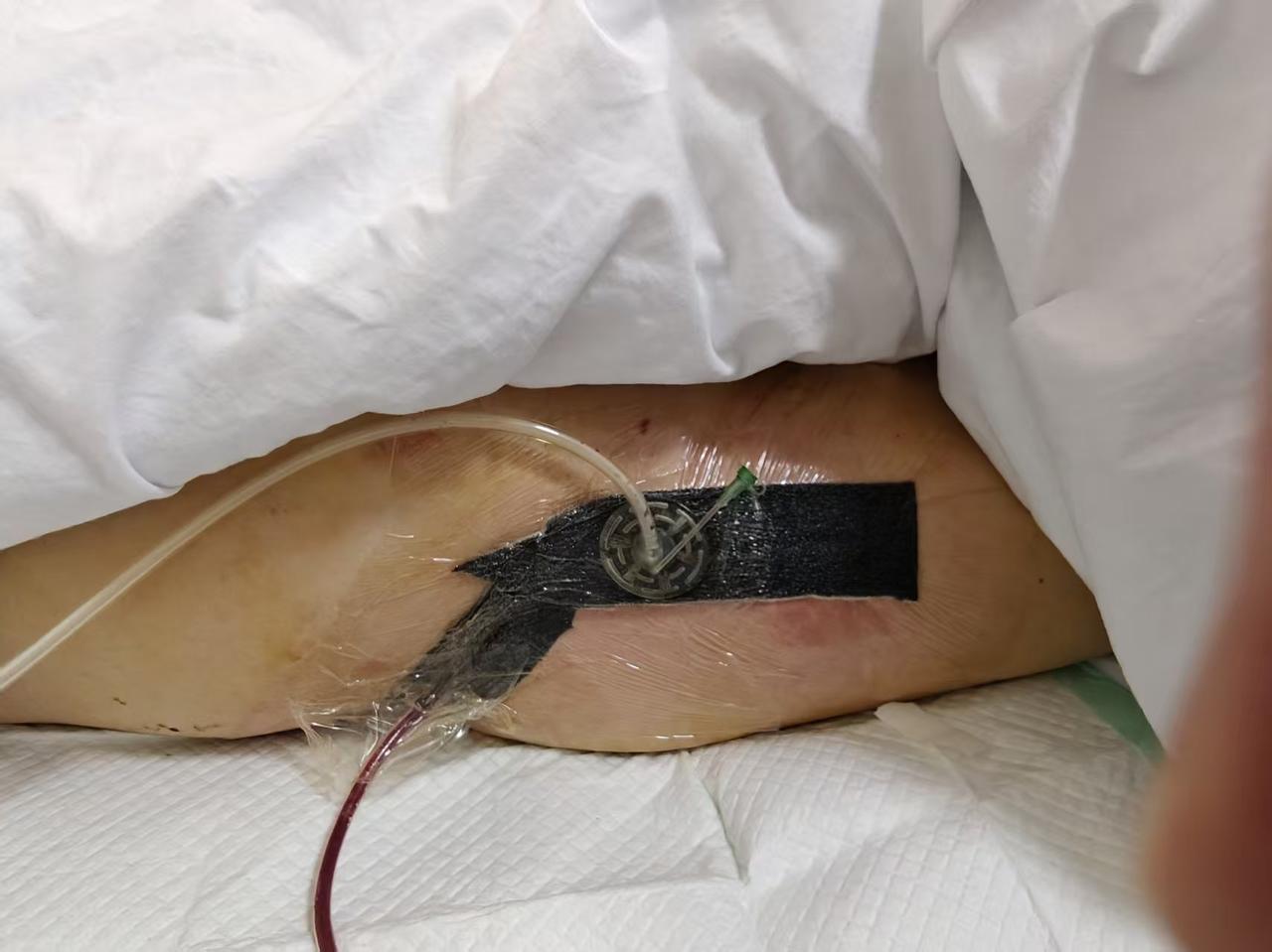 我爸74岁，2010年做髋关节置换术，2025年又做了翻修术。20厘米的刀口。他