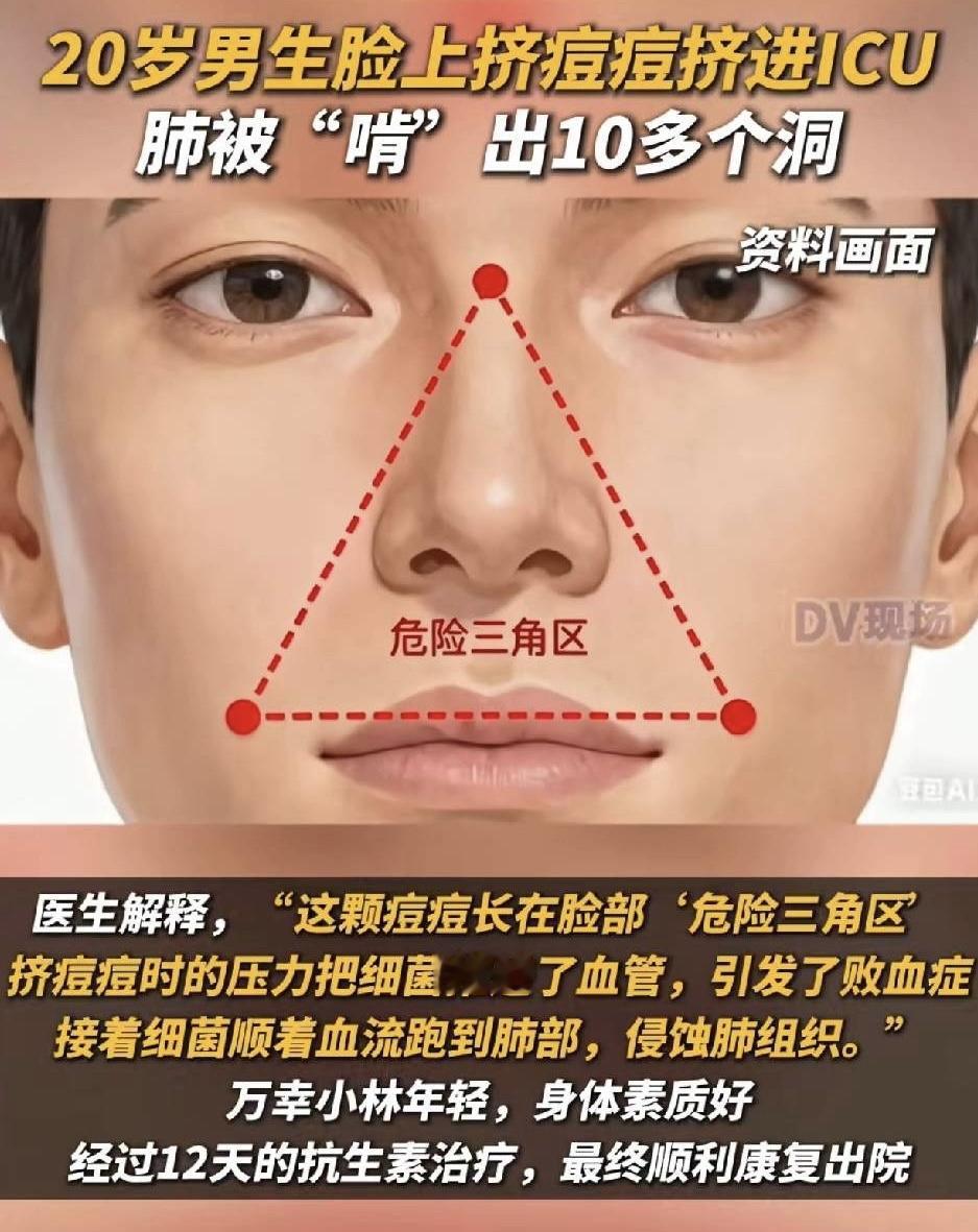 20岁男子挤痘痘挤进ICU肺被“啃”出10多个洞，这事儿听起来太吓人了。男生小林