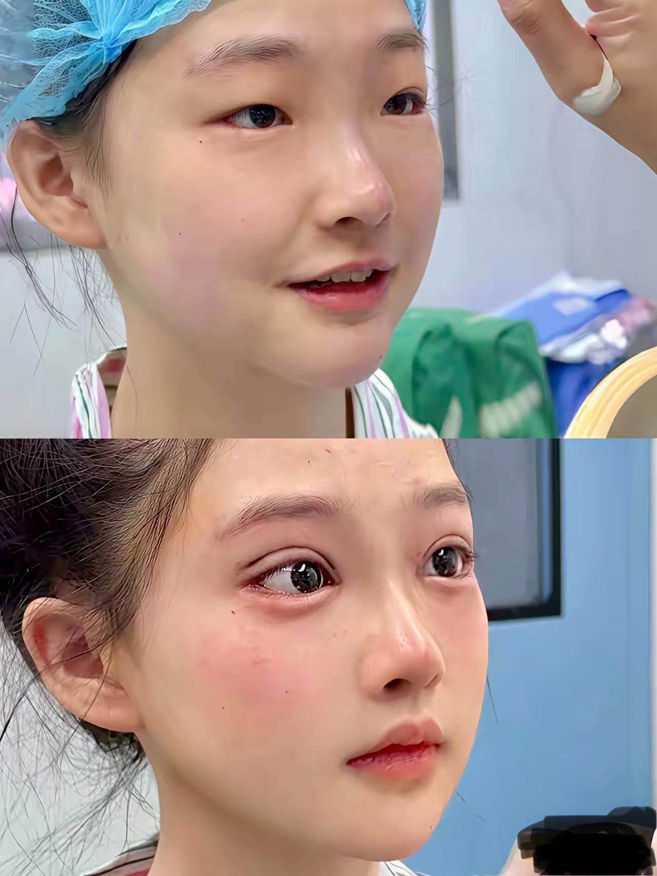 这或许是很多女生都乐意去做双眼皮的原因吧？看看这模样，变化实在太大了，完全是两