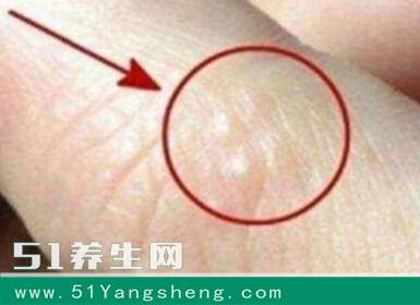 手上出现这种东西, 代表肝脏已经病变, 不能再耽误下去了