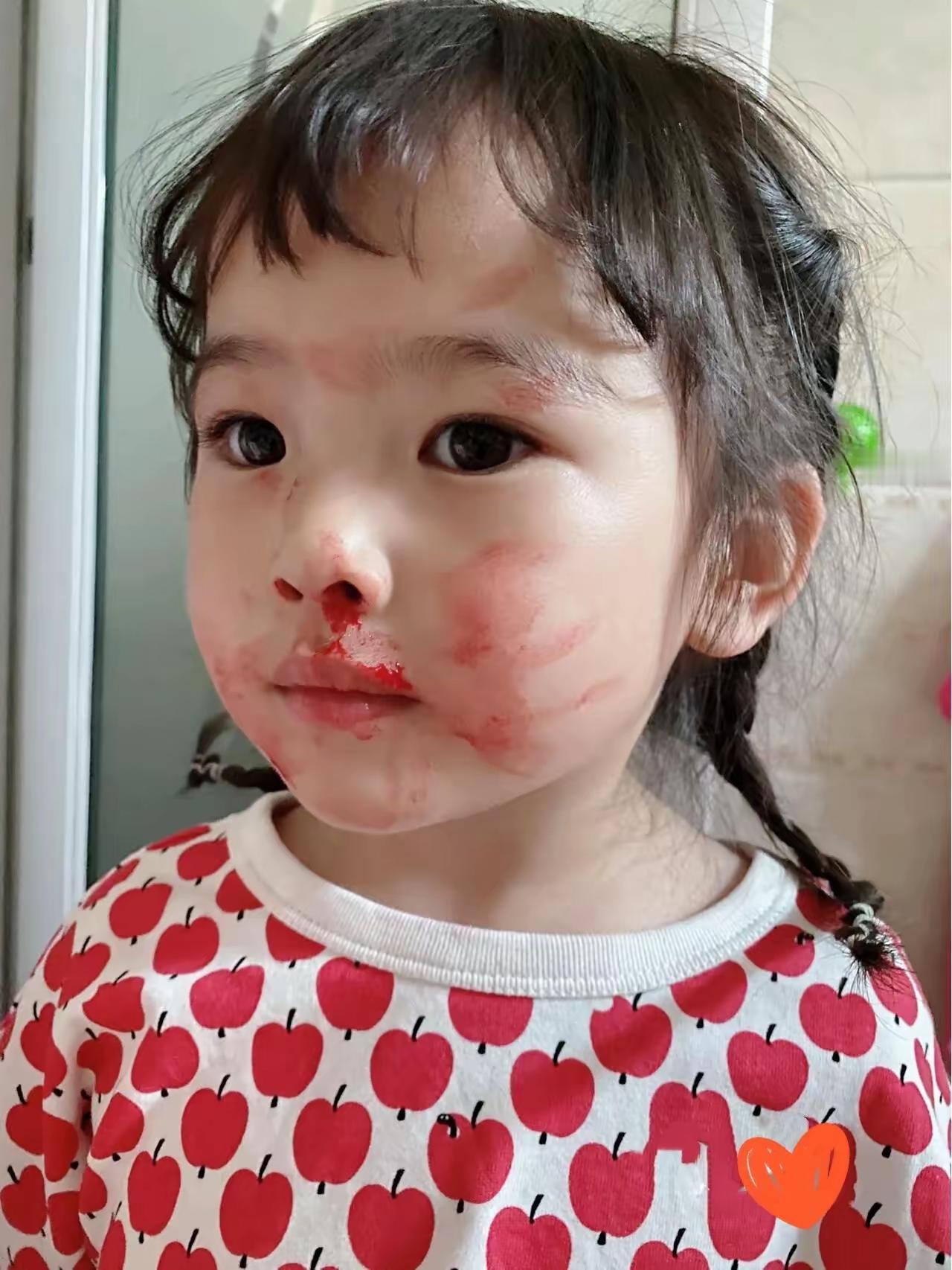 救命！3岁娃反复流鼻血愁死妈！跑遍诊所都说正常，可血还是三天两头哗哗流😭纸巾