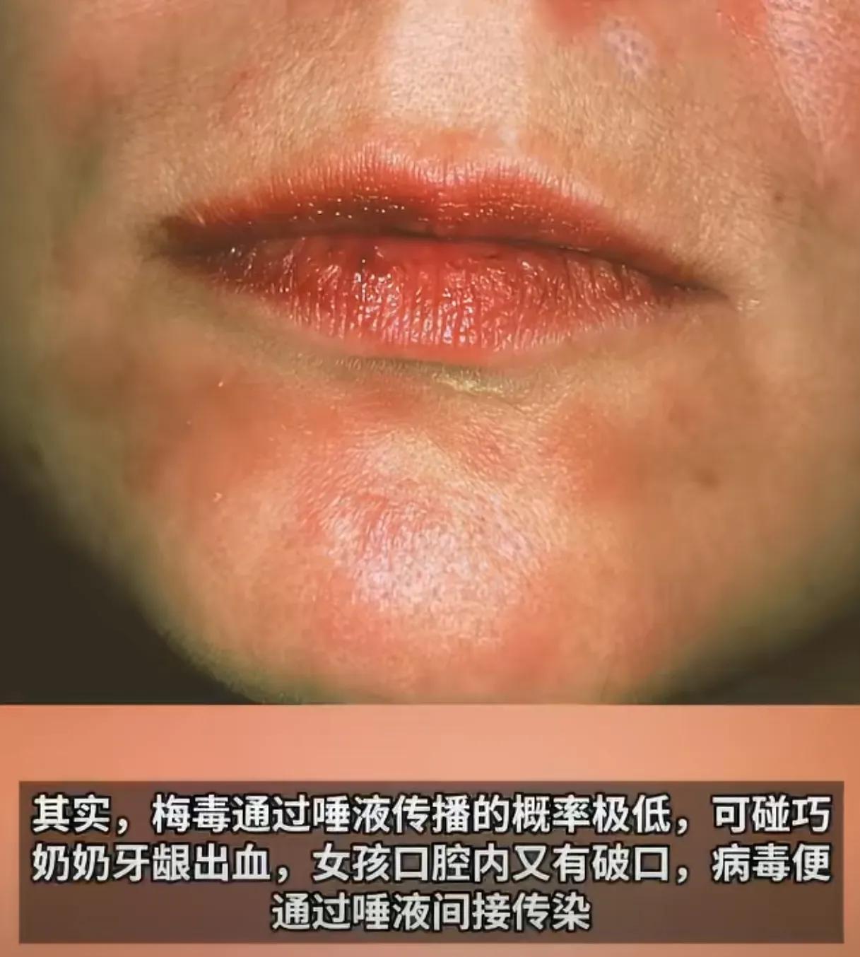 安徽一个才四岁的小女孩，竟然被查出感染了梅毒。在很多人的印象里，梅毒几乎等同于性