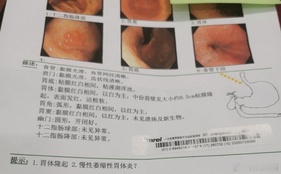 胃息肉：绝大多数胃息肉都是良性的，多以胃底腺息肉，增生性息肉为主，也很少进一步进