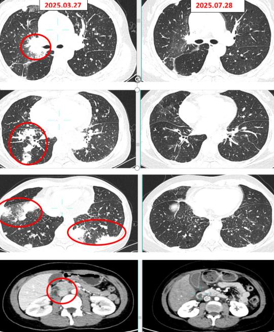“不幸中的万幸”！2023年，福建福州，一女子体检时，发现肺部有数个小结节，但她