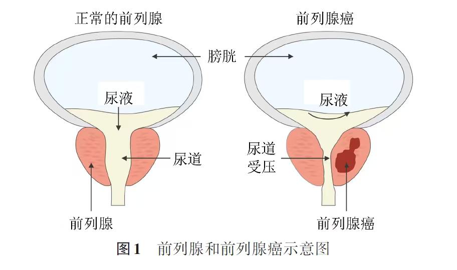 前列腺癌就是男人才会得的、长在前列腺这个器官上的恶性肿瘤，中老年男性高发，早期几