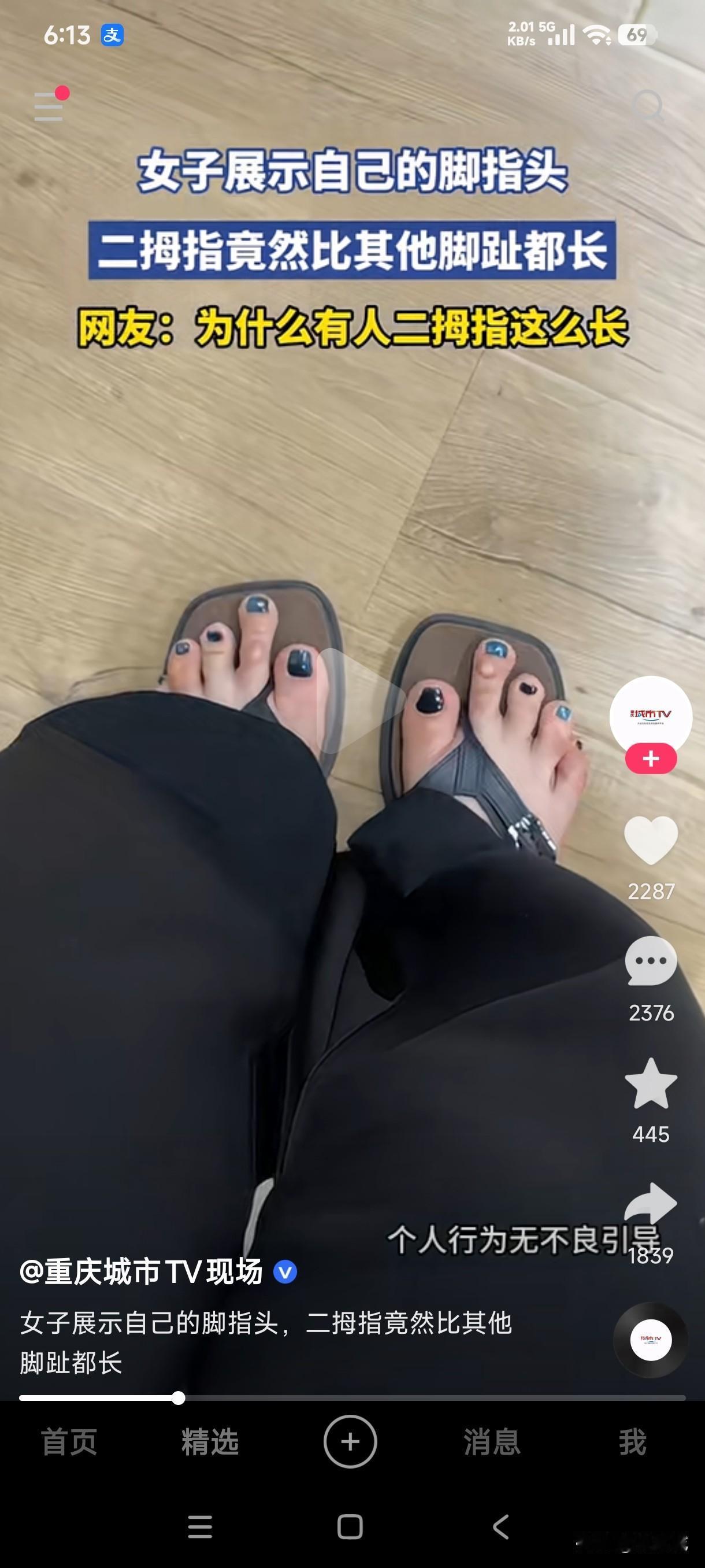 女子展示自己的脚趾头，二拇指居然比大拇指长那么多，这买鞋能买到合适的吗？别人都是