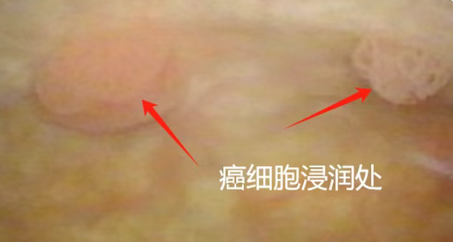 不痛不痒一查竟是癌? 这5种“悄无声息”的癌症, 很多发现已是晚期