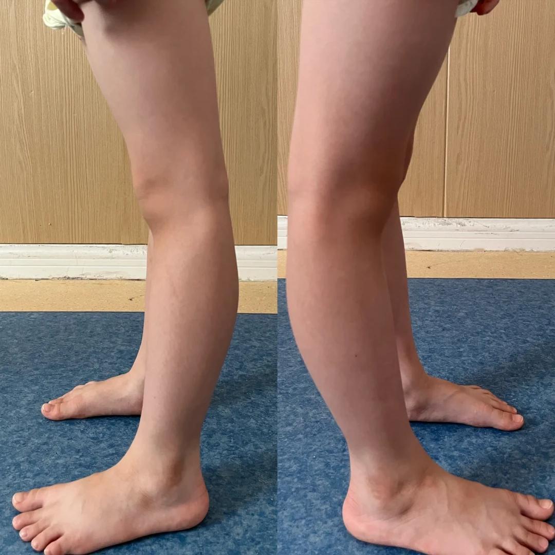 偏瘫膝过伸别慌张，这样调整还来得及！1.膝盖疼痛难以避免当膝盖长期处于过