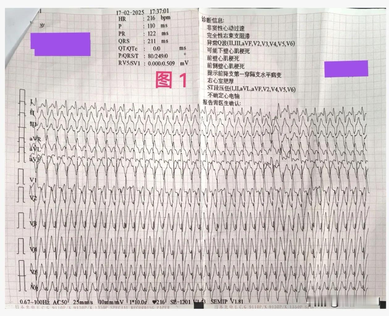 男性患者，43岁，因突发心悸来诊。心电图示宽QRS波性心动过速，频率216次/分