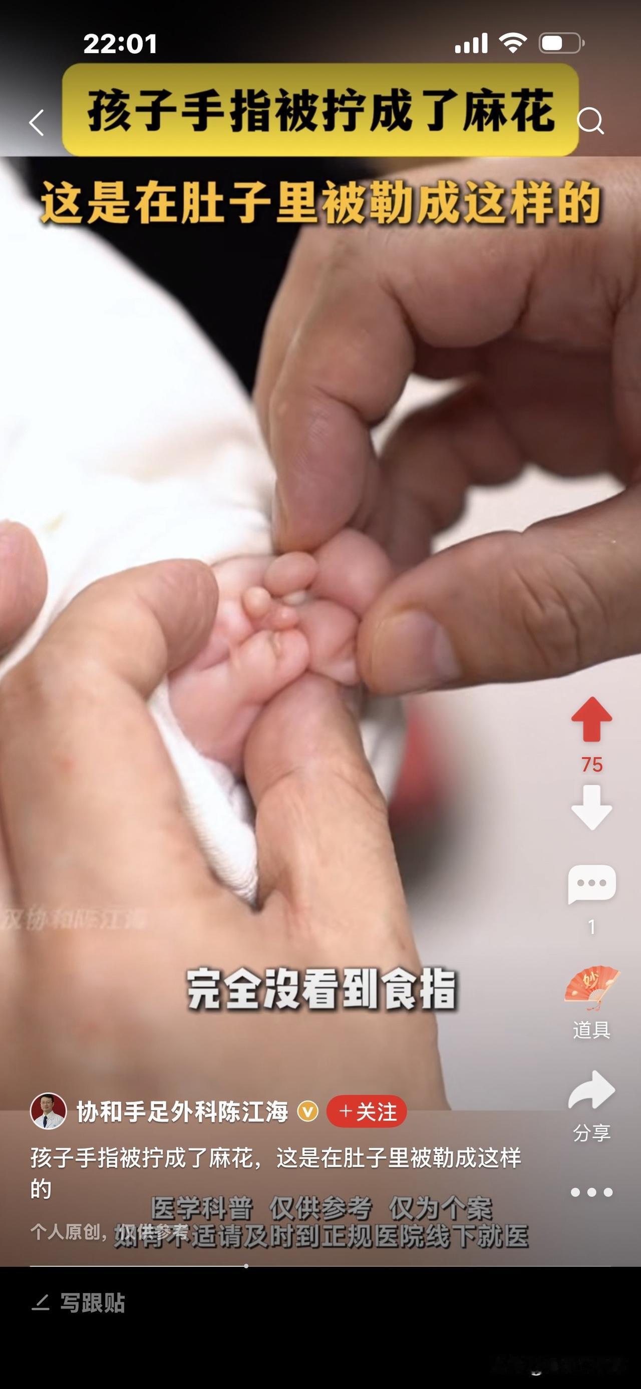 罕见！这婴儿的手指只有几根肉牙状的肉团，像一朵小花一样，明显畸形，协和手足外