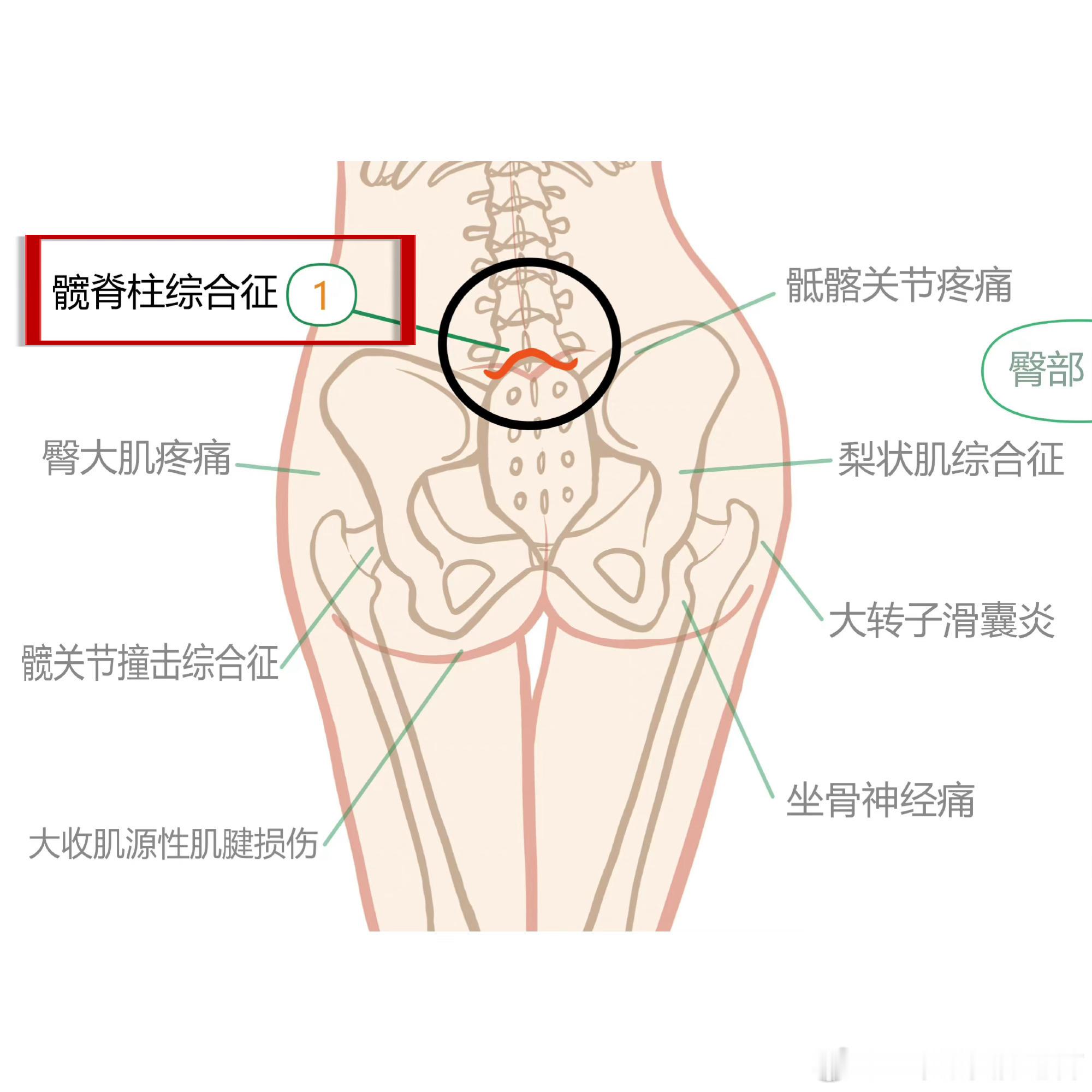 臀部疼痛【臀部疼痛自查攻略】腰痛？屁股痛？腿疼？包括还有朋友会腹股沟不适。今