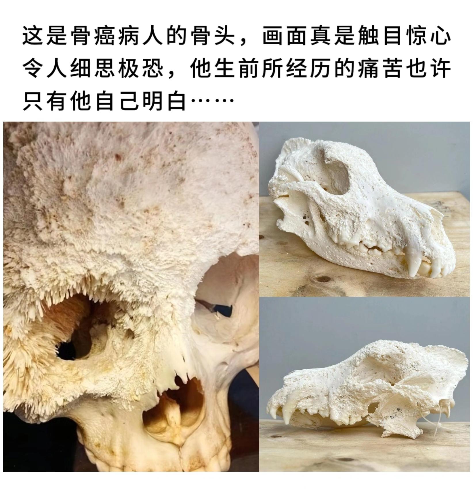 这是骨癌病人以及动物的骨头，画面真是触目惊心令人细思极恐。