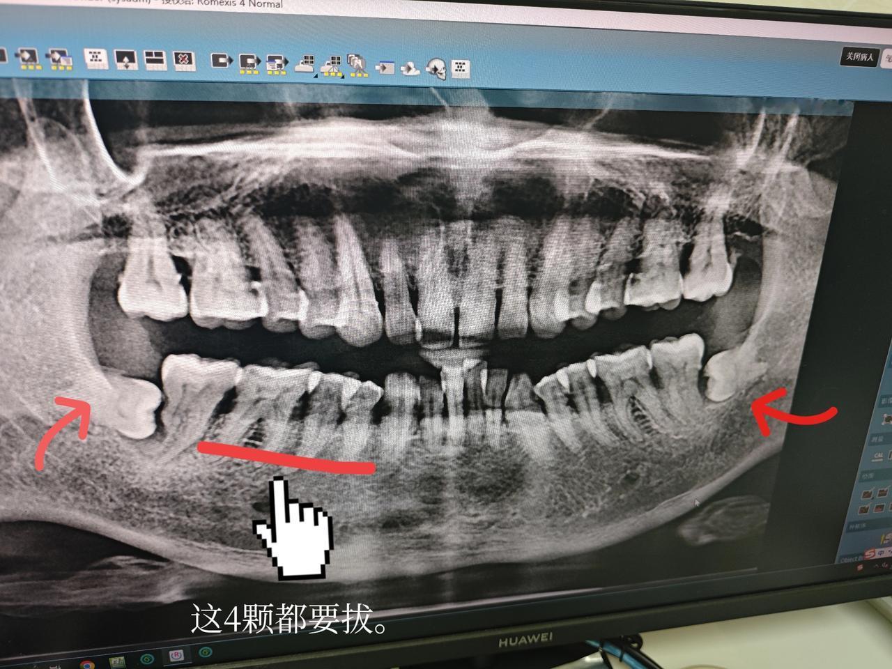 千万不要听医生的，牙齿一痛就去拔。前段时间我因为牙齿痛，牙龈发炎，牙齿就松动了