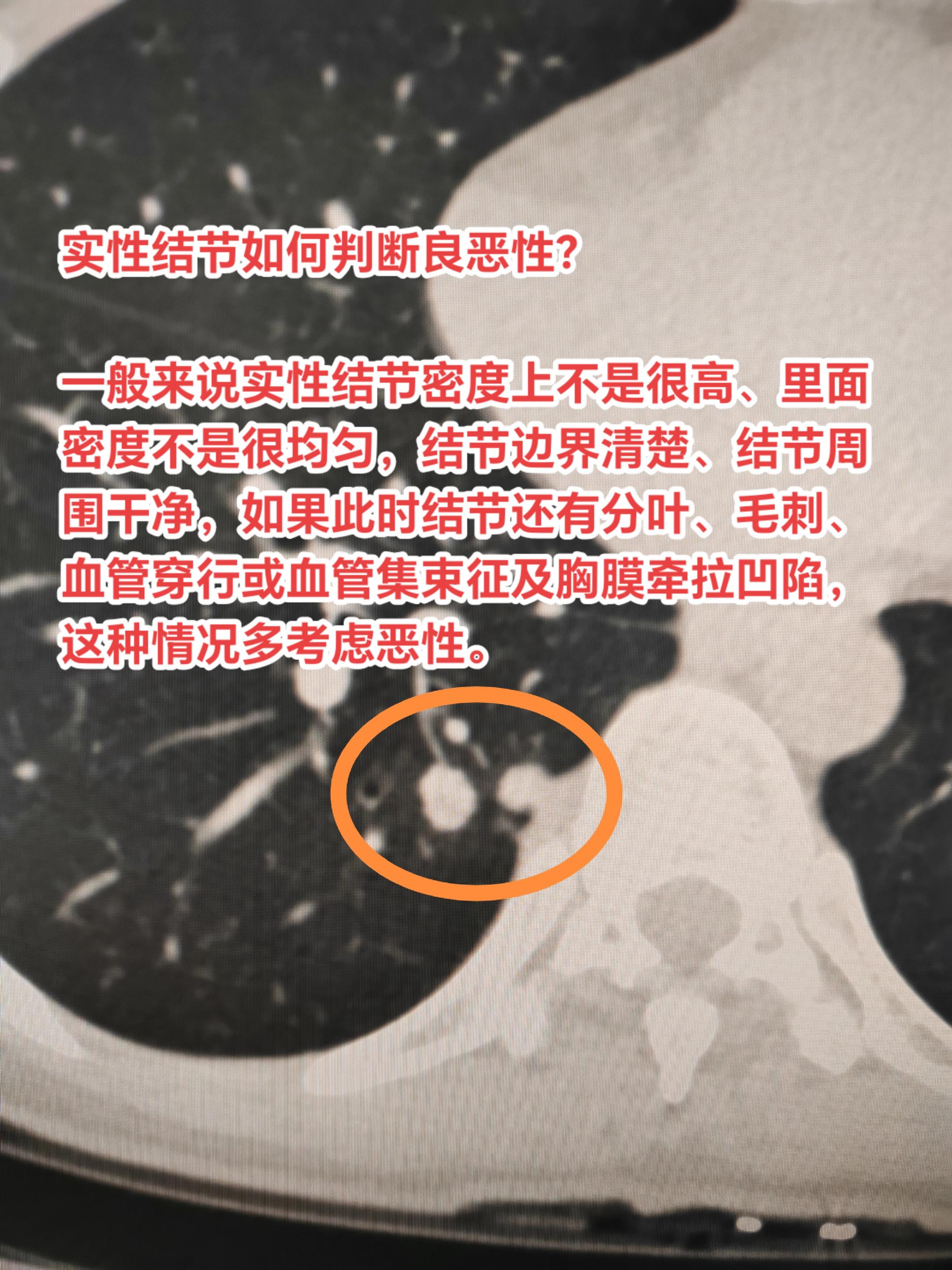实性结节如何判断良恶性？一般来说实性结节密度上不是很高、里面密度不是很...