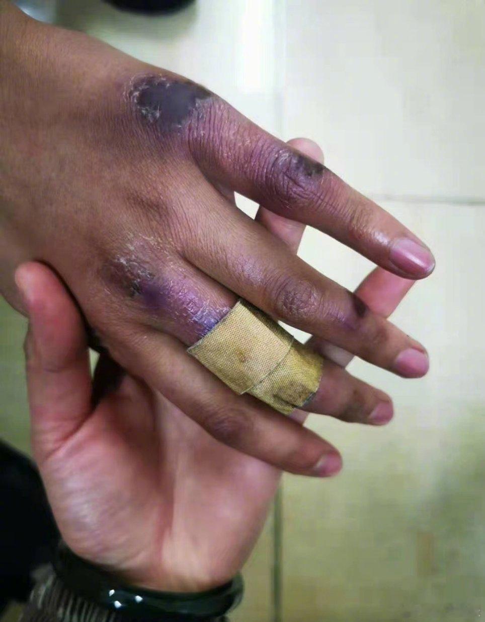 这是一双边防女兵的手，心疼致敬中国军人！