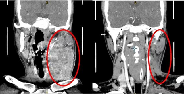33岁男子从口腔溃疡到舌癌转移仅2个多月, 来沪手术切除4/5舌头