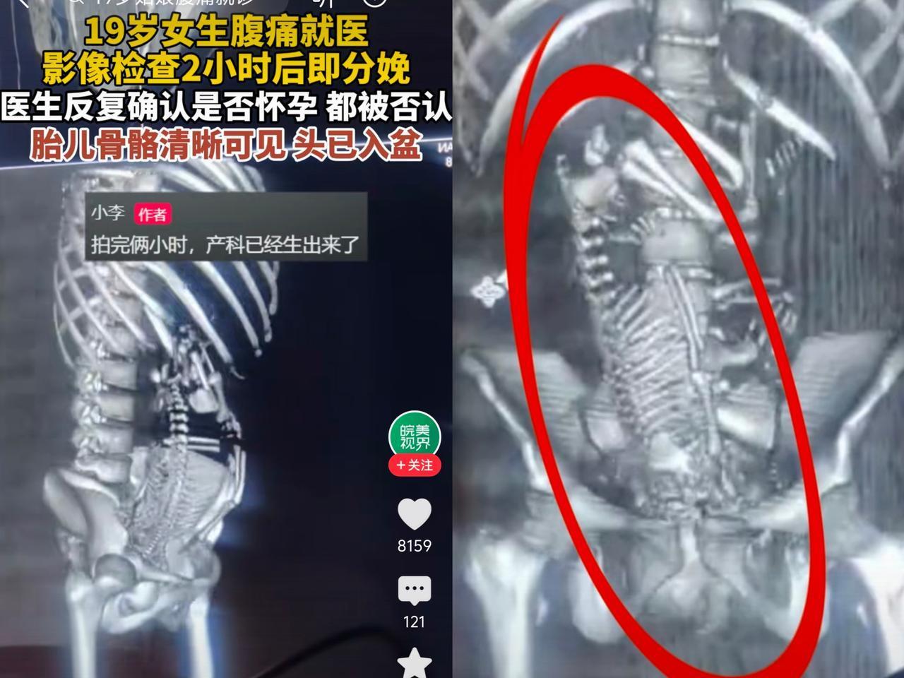 19岁女生腹痛就医影像检查2小时后即分娩。医生反复确认是否怀孕，都被否认意外