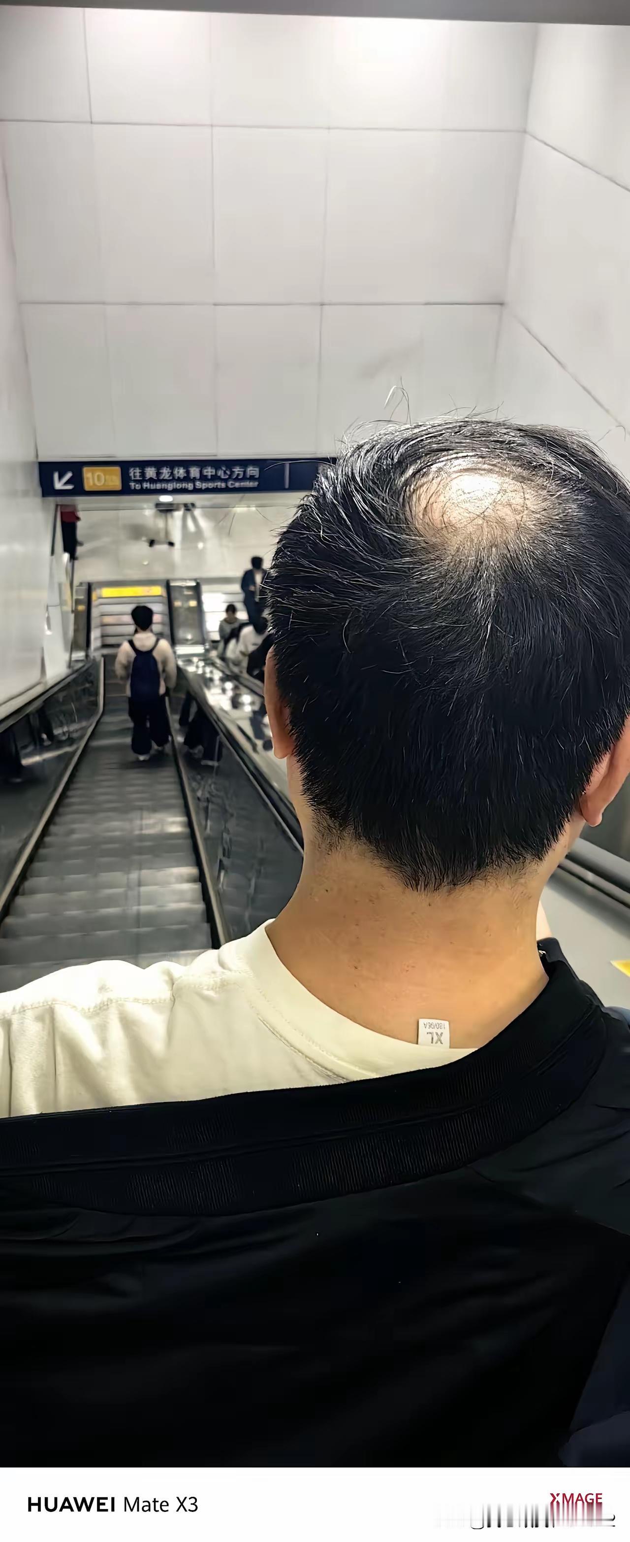 年纪轻轻，早已秃头了，这到底是为什么？压力太大，还是其他原因？为啥现在秃头的