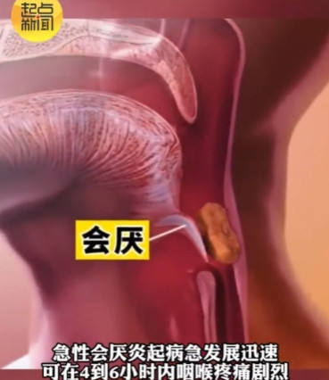 感冒差点丧命！”近日陕西一男子半夜睡醒发现嗓子像刀片一样疼，以为是普通感冒，到医