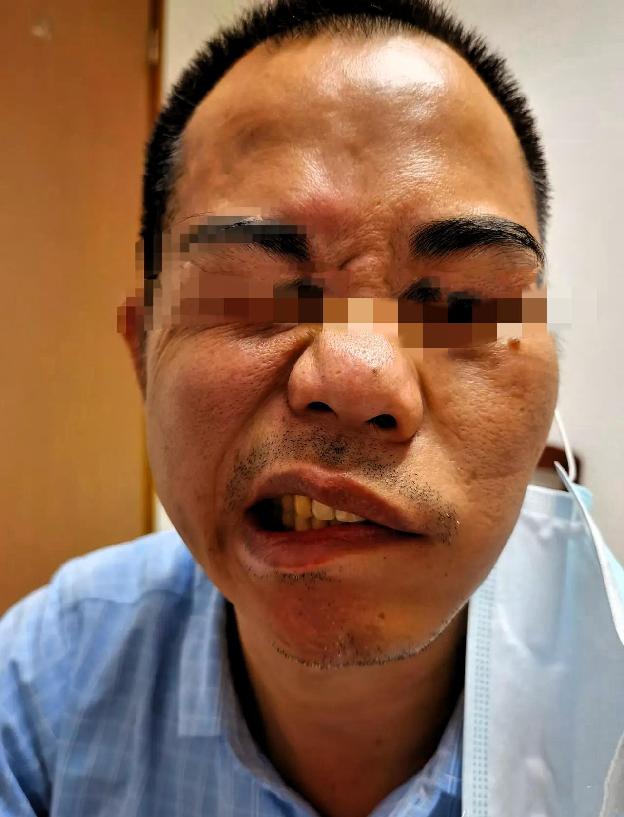 昨晚太热了，50多岁的大哥，不舍得开空调，对着风扇直吹了一整晚！平时他作息规