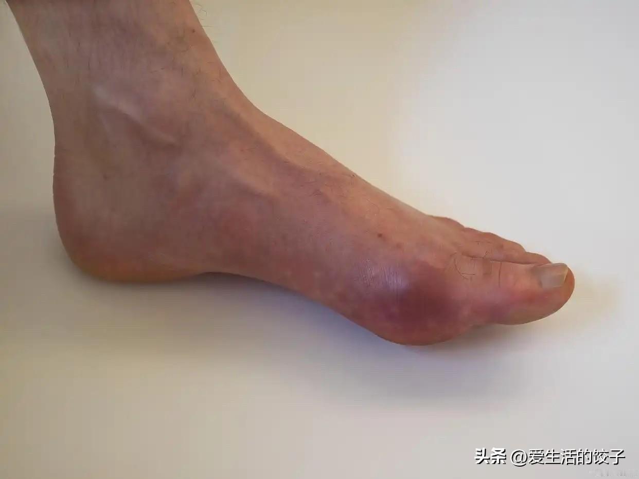 老爸痛风了！一个脚肿得亮晶晶！这次痛风肿成这样，就是肉和肉汤吃多了。告他以后