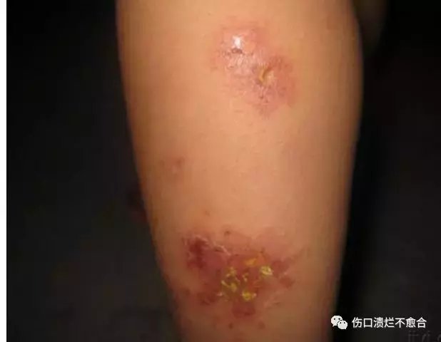 皮肤皮下组织化脓性感染以上三种感染的炎性肿块可化脓破溃后形成溃疡