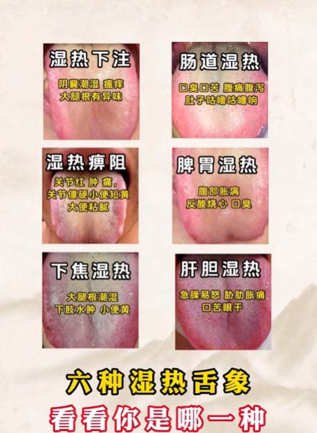 中医所说的湿热，可停在人体不同脏腑、部位，对应的身体感受与舌象表现各有不同。下面