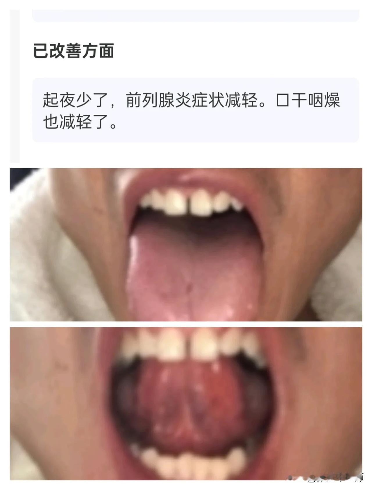 慢性前列腺炎！八个提示肾透支了:（1）口喝:喜欢喝温热水（2）口粘、晨起