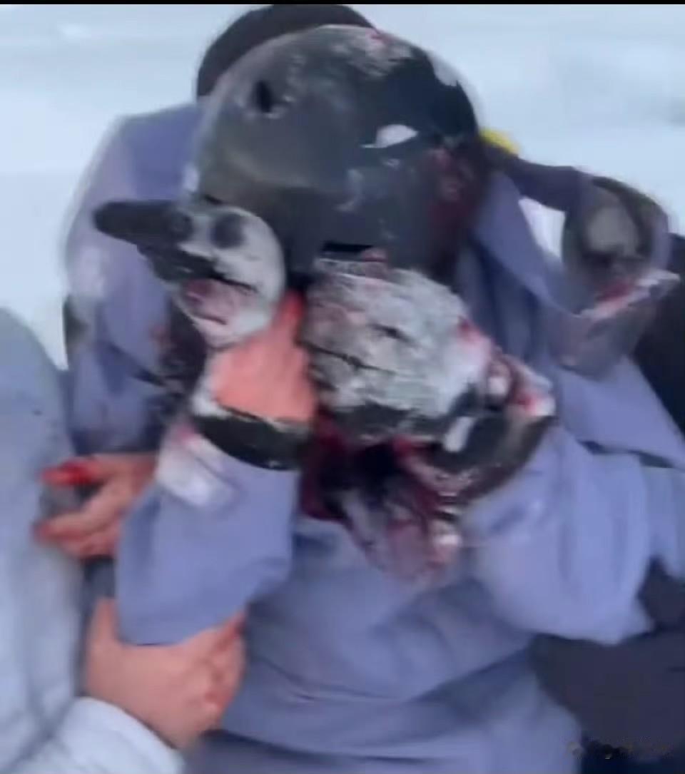 出事了‼️游客被新疆的雪豹咬伤，满脸是血。近日新疆可可托海景区一只雪豹突然从雪