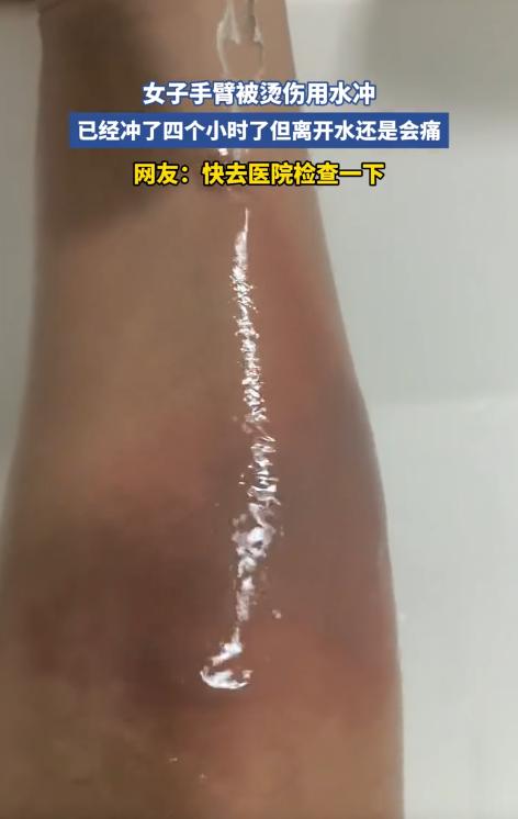 山东，一女子做饭时手臂不慎被热油烫伤，牢记“烫伤要冲水”的她第一时间打开水龙头冲