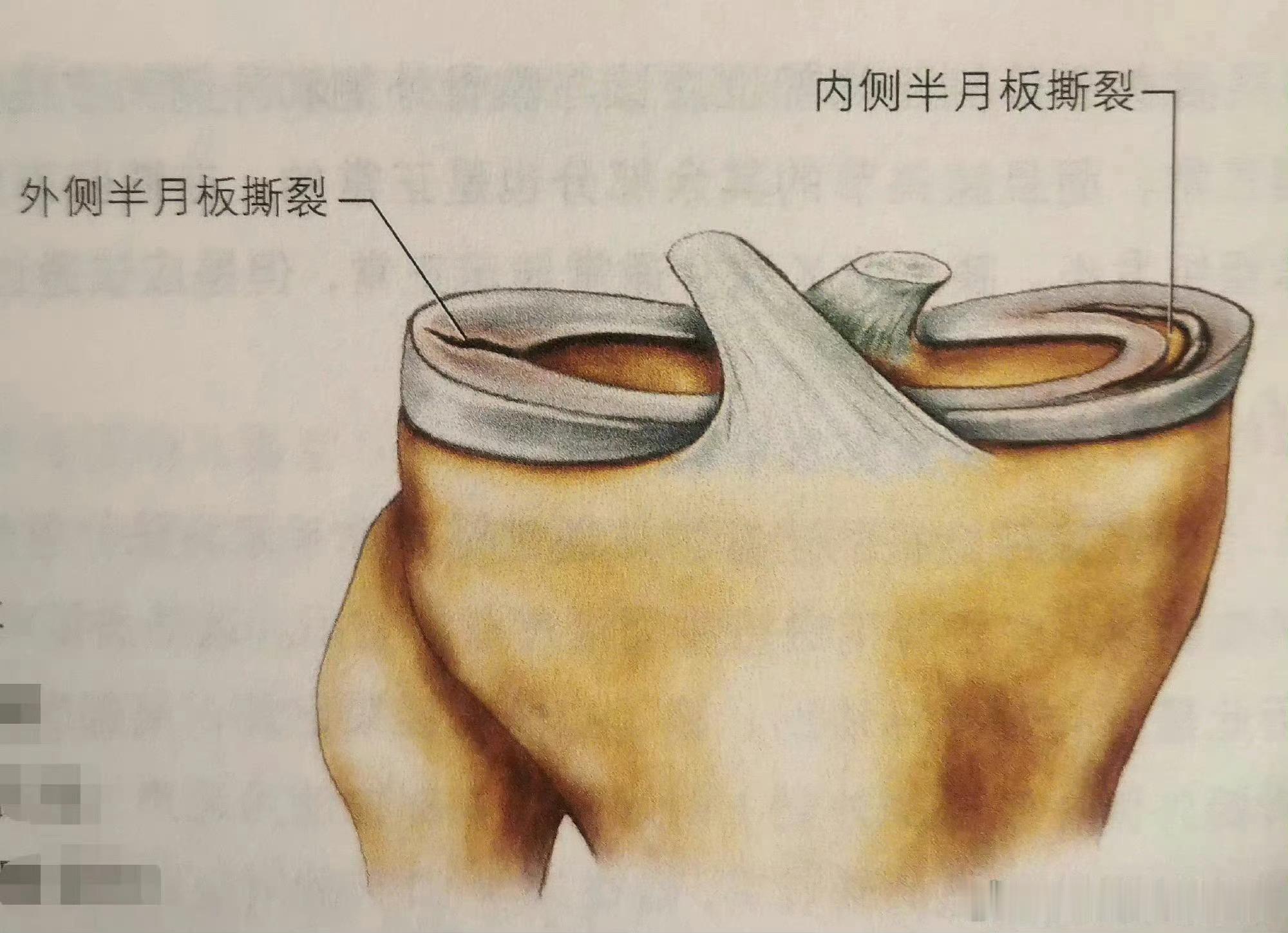 不知道你有没有听说过——“魔鬼三联征”？这个损伤是指我们的前交叉韧带➕内侧副韧带