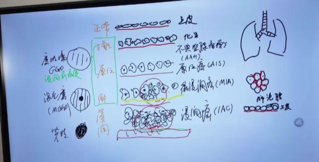生活中很多查出肺结节的朋友，都会有同一个疑问：从普通的肺结节一步步发展成肺癌，到