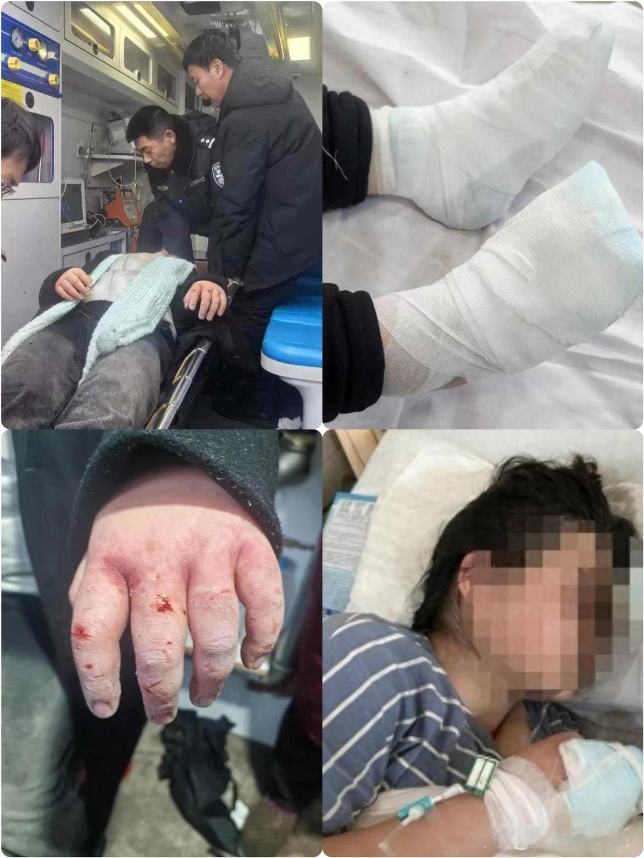 四川女大学生到东北游玩晕倒雪地冻伤，左手三根手指或面临截肢！2300余名爱心