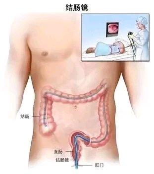 总感觉拉不干净，肛门像有东西堵着，这可不是小事！医生说这可能是肠癌“伪装”。医学