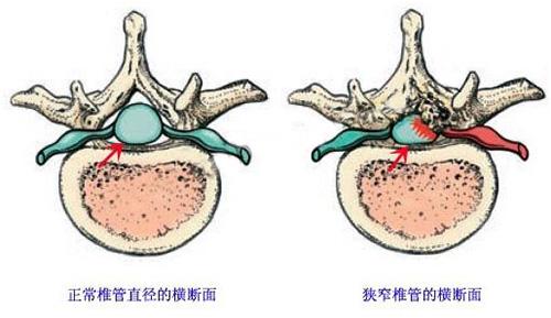 腰背痛是腰间盘突出还是腰锥管狭窄?