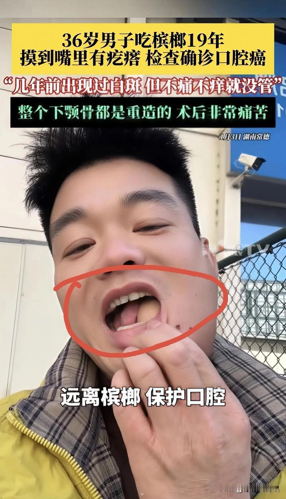 嘴里长白斑没当回事，36岁男子嚼槟榔19年确诊口腔癌！36岁的张先生嚼了19年