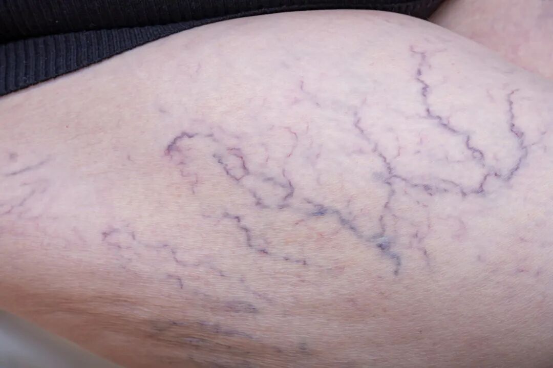 这种腿上最爱长的“红色纹路”, 拖着不管真的会坏事!