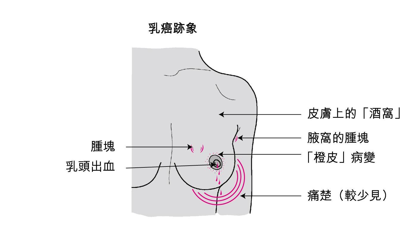 ar和ki-67在三阴性乳腺癌中的表达及临床意义