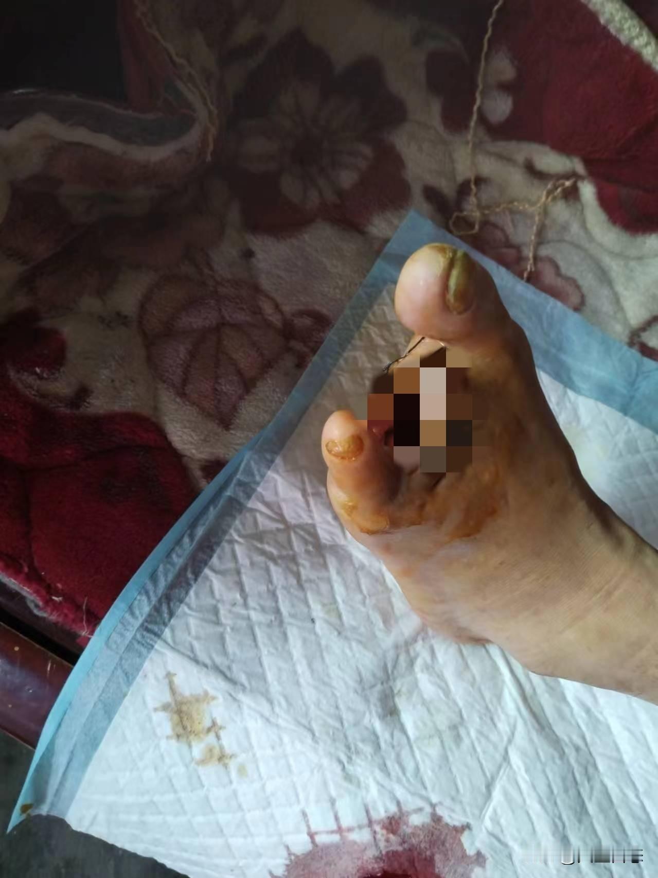 身患糖尿病多年的25岁离异女人，脚趾截肢后又开始溃烂！“我不知道自己能活多久