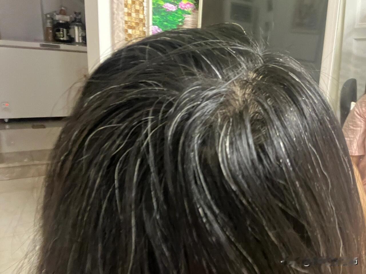 23岁少白头有办法治嘛初中就长了高中开始变多一点点遗传我爸也有但是也不