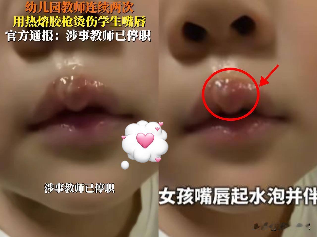已经有家长出来发声了，​原来在热熔胶烫嘴之前，​就已经有一批孩子被烫过了，而