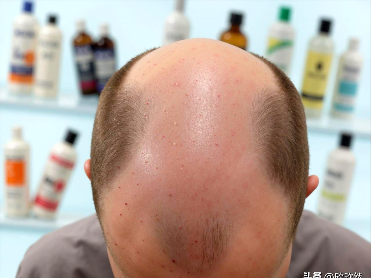 你有没有发现，身边40多岁的老哥们儿，头发好像都不太富裕？我闺女前几天就掰着手