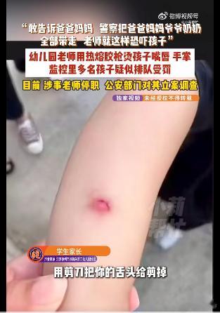 幼儿园老师疑威胁剪掉幼童舌头幼儿园儿童被老师用热熔胶烫到感染不是给这个恶魔老师