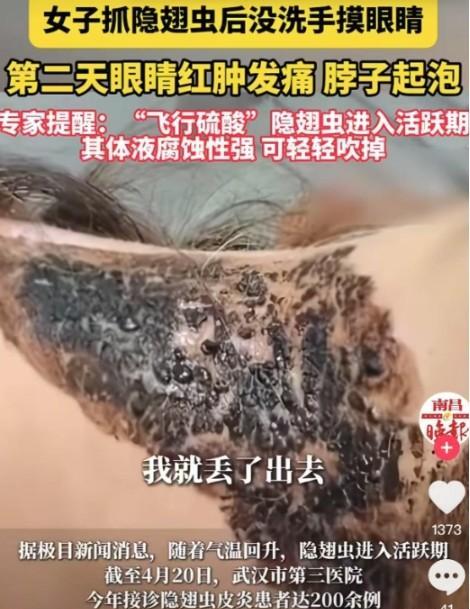 4月24日，湖南怀化，一女子在脖子上发现隐翅虫，一巴掌将其拍死，女子并没有洗手，