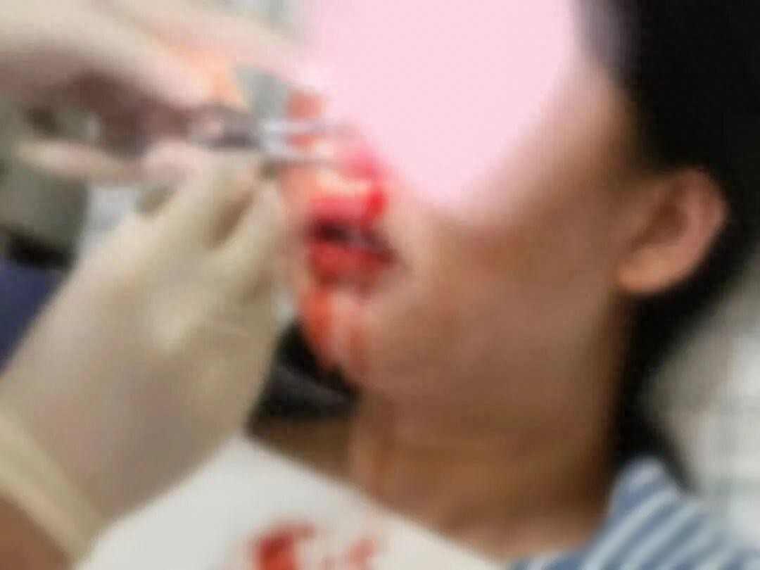 触目惊心！孕期疏忽，鼠药竟让孩子“带毒”出生，鼻血只是冰山一角！深圳一名孕妇