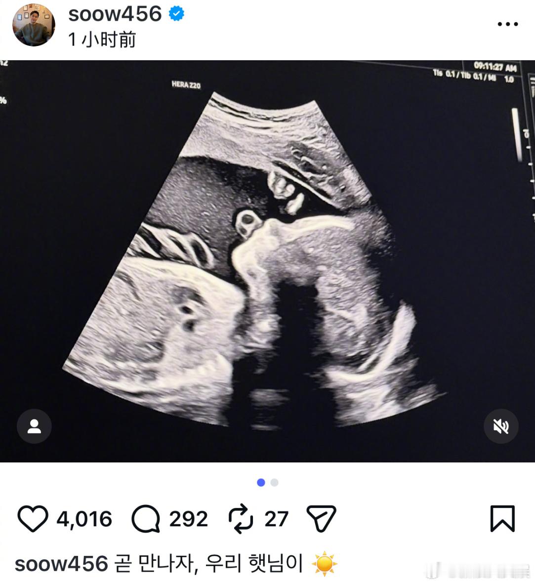 宋承炫当爸宋承炫老婆怀孕21日，前FTISLAND成员宋承炫晒宝宝B超照，宣布