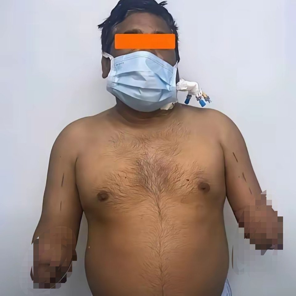 印度双手移植手术这手术的主人翁以后看着这双手会不会害怕怕？