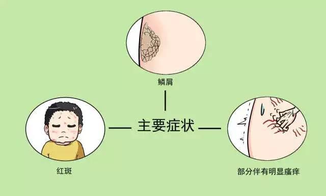 珠海易达康: 小儿银屑病需要谨慎对待