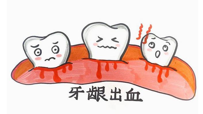 牙齿每天都出血是什么原因引起的牙齿每天都出血可能是刷牙方法不当、饮食不均衡、