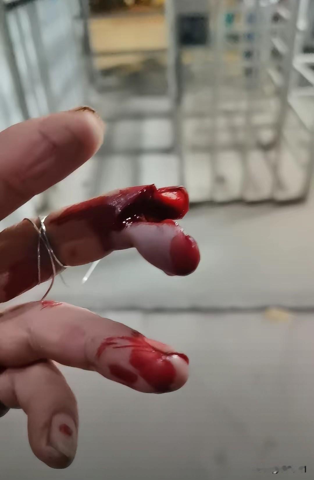 一定要注意安全！我有一个朋友第一天到工地上班就出这么大的事，手指头被干断了一节，